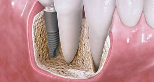 Implantology